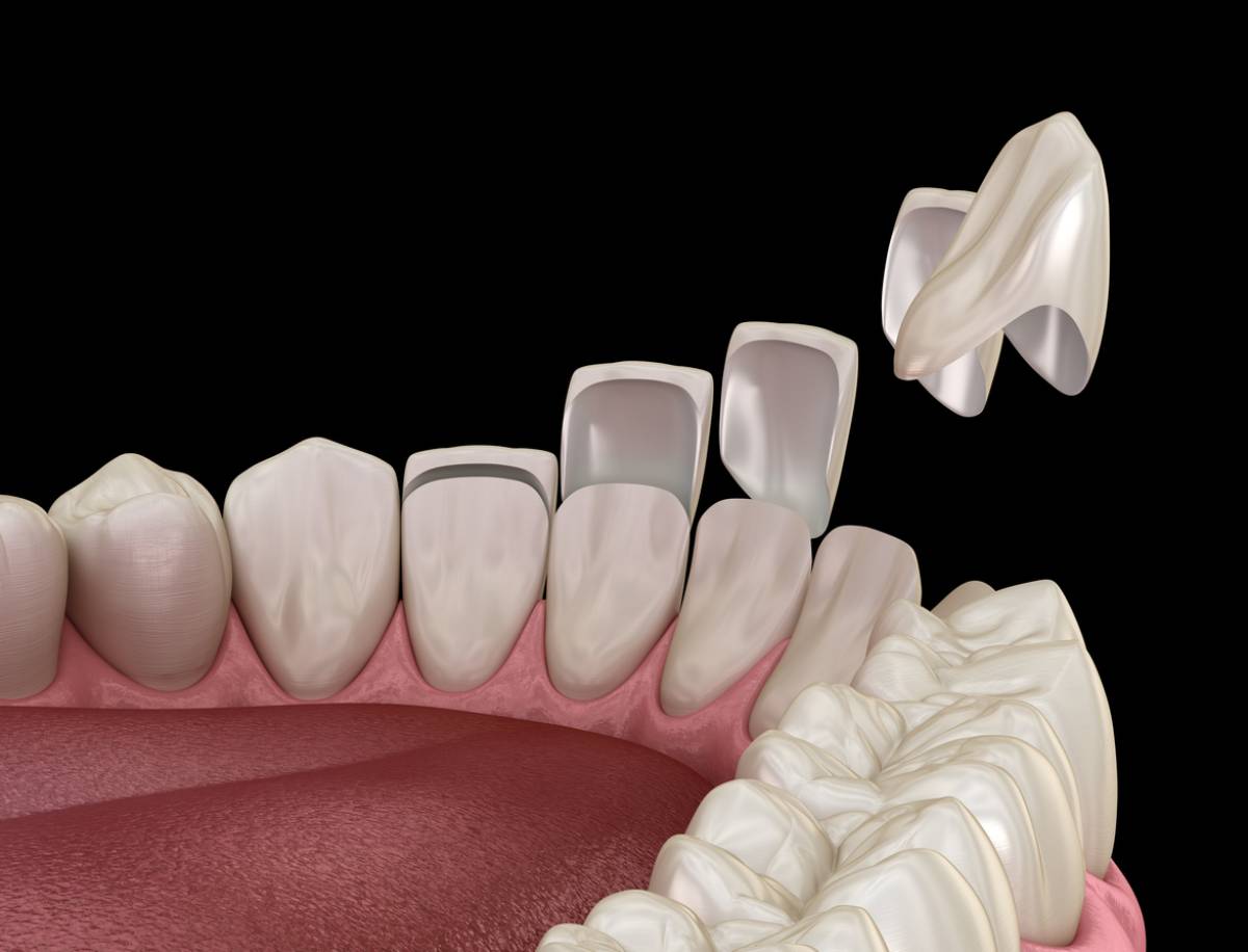 Can veneers fall off?
