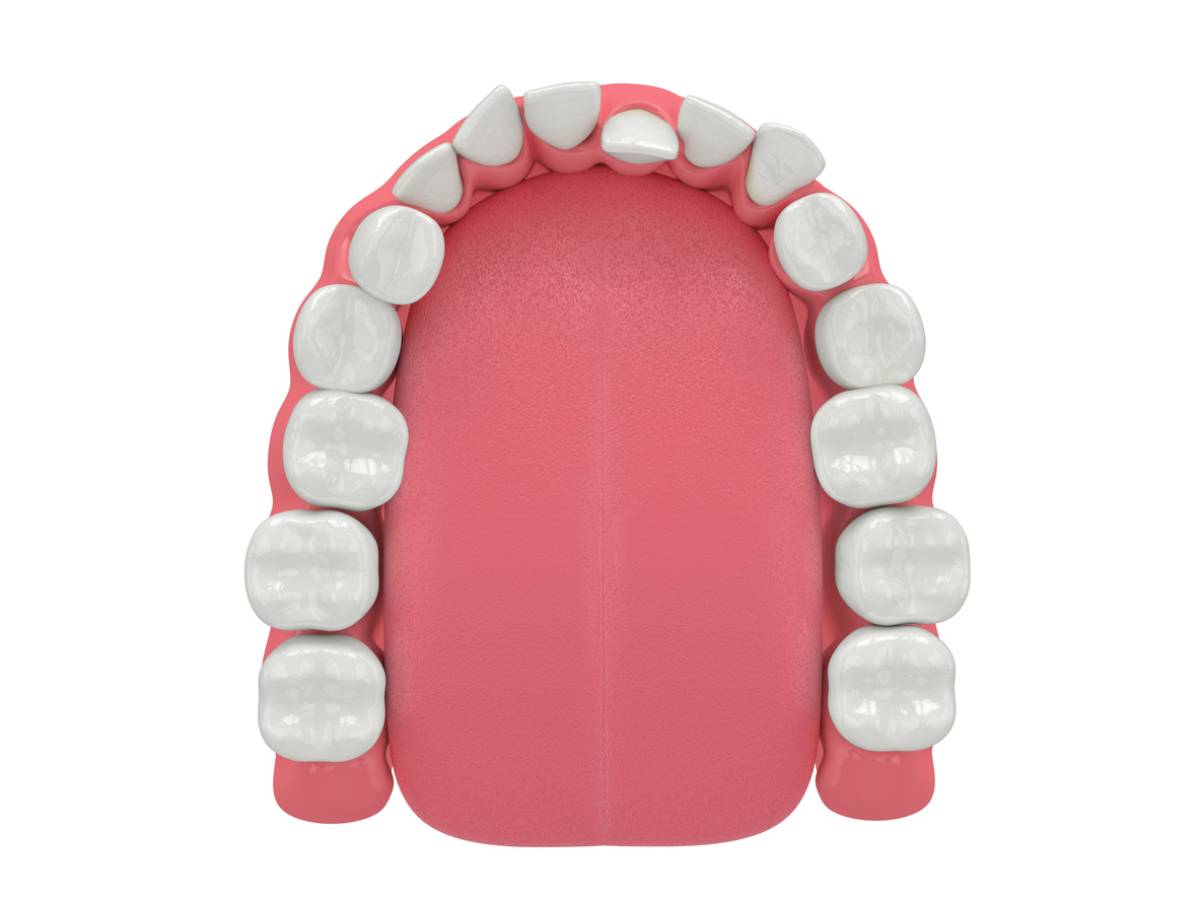 3d render of crooked teeth in jaw.