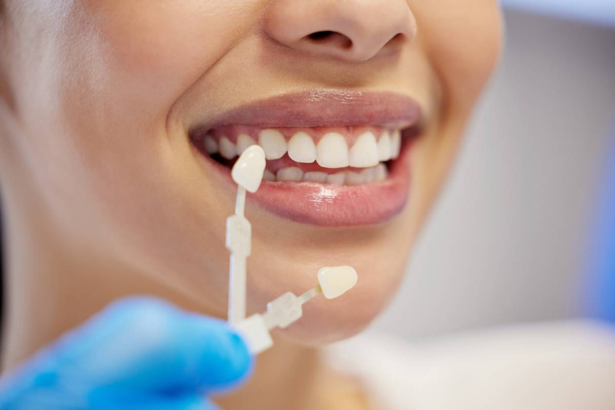 featured image for does it hurt to get veneers