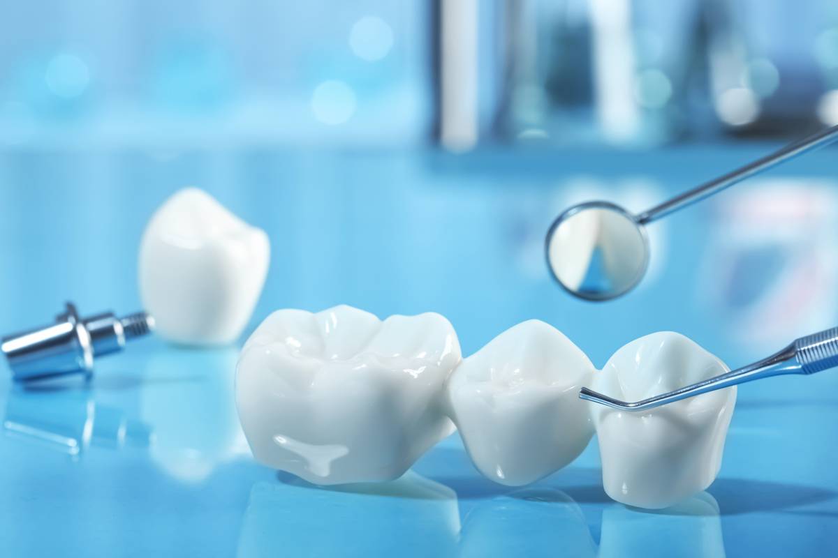 featured image for how to choose dental implants or bridges