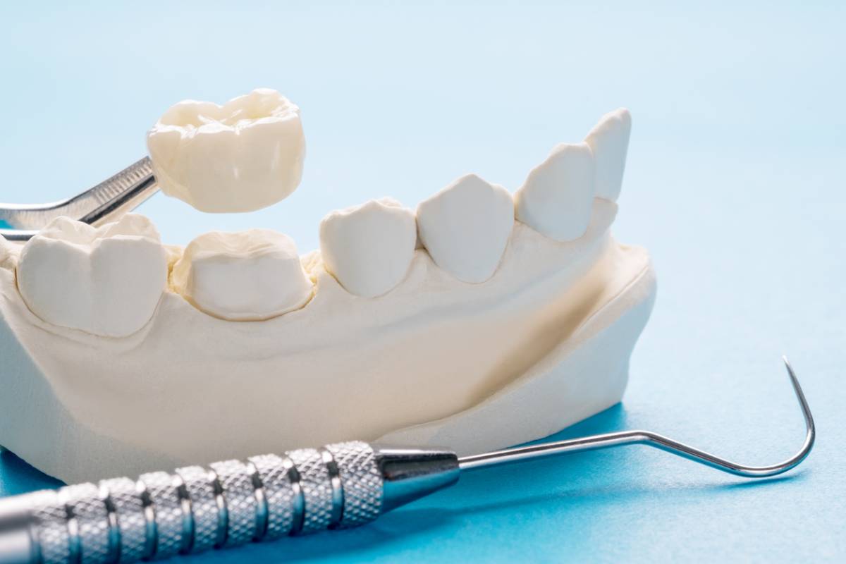 dental crowns going on jaw model