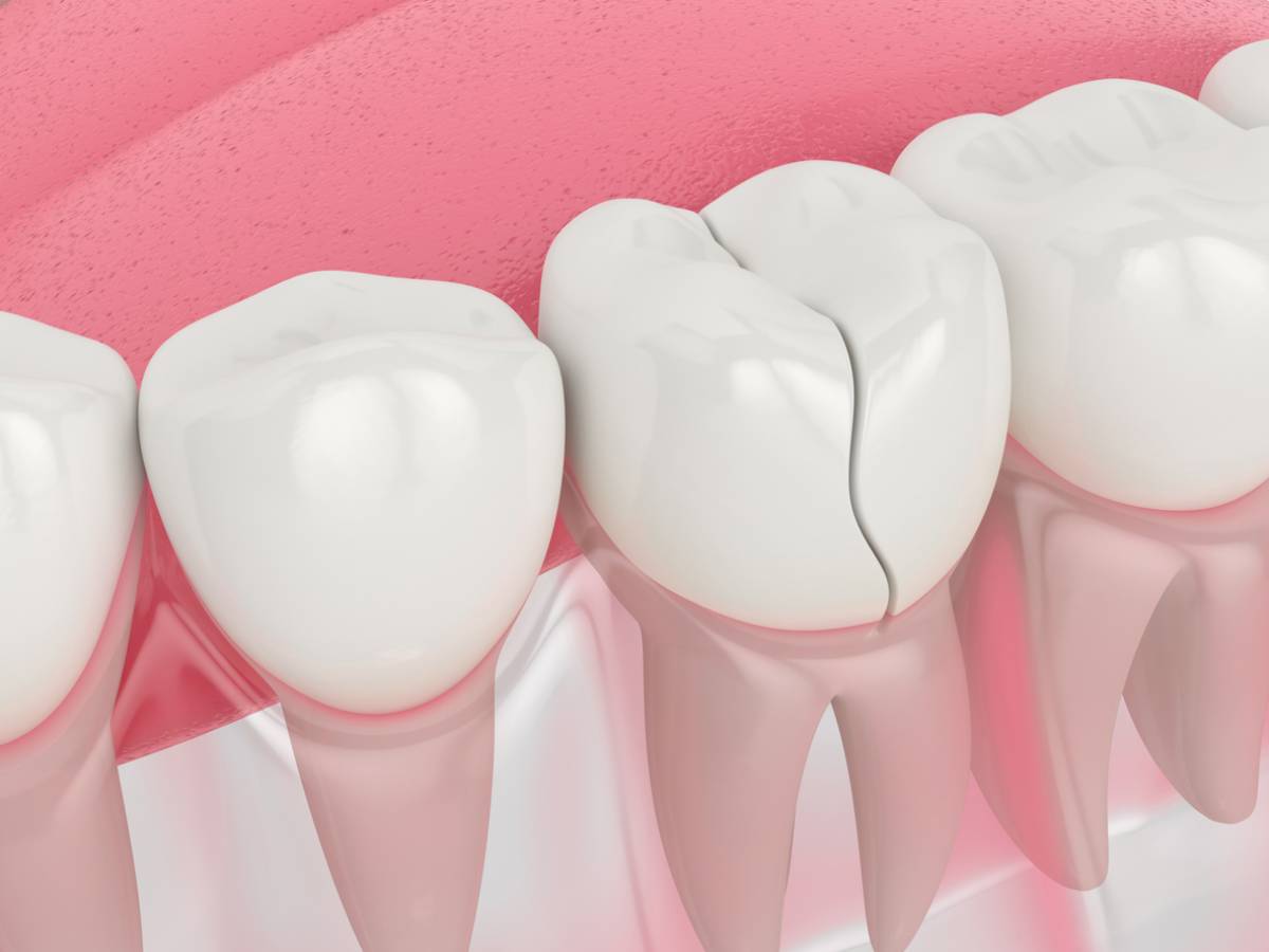 Broken tooth among other healthy tooth illustration.